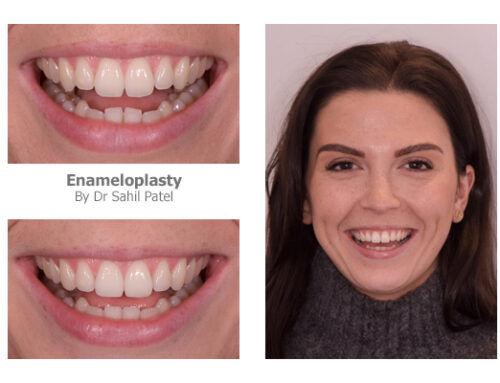 Tooth Contouring 04