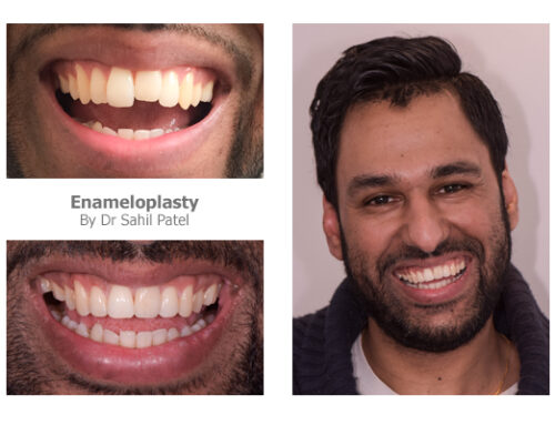 Tooth Contouring 03