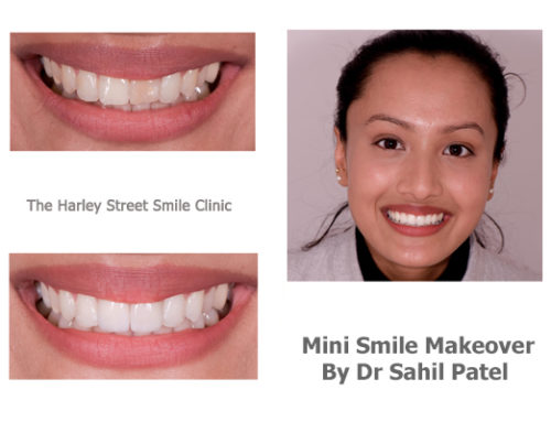 Mini Smile Makeover