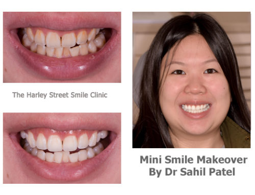 Mini Smile Makeover 05