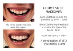 Gummy Smile Makeover Harley St Smile