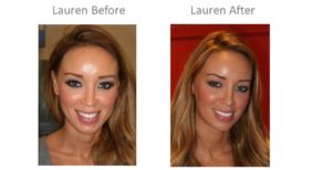 Lauren Pope TOWIE teeth - Harley St Smile