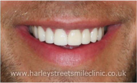 veneers implants vs which resin porcelain