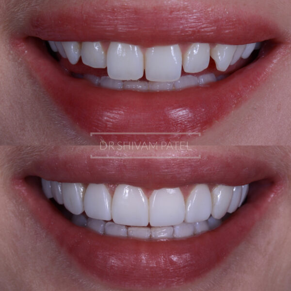 Professional Teeth Whitening and Home Whitening - Harley ...